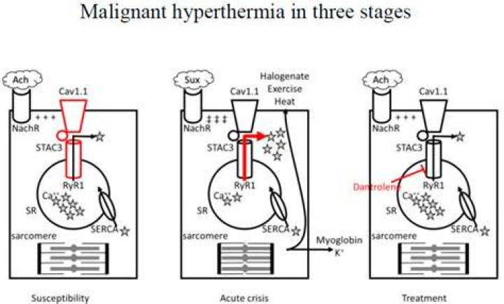 Does succinylcholine trigger malignant hyperthermia?