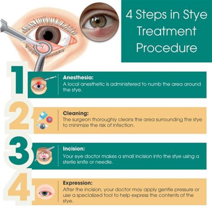 How do styes drain?